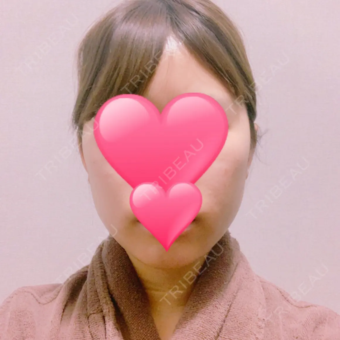 バッカルファット除去 / 脂肪吸引（顔） / 輪郭修正 / ボトックス（あご） / ヒアルロン酸注入（あご） / ボトックス（エラ・小顔） エートップ美容整形外科 DAY 0