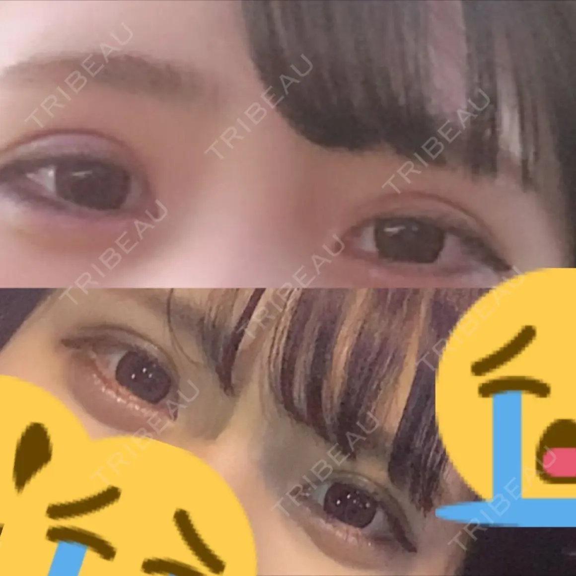 二重切開 / 上まぶたの脂肪取り 共立美容外科 大宮院 AFTER