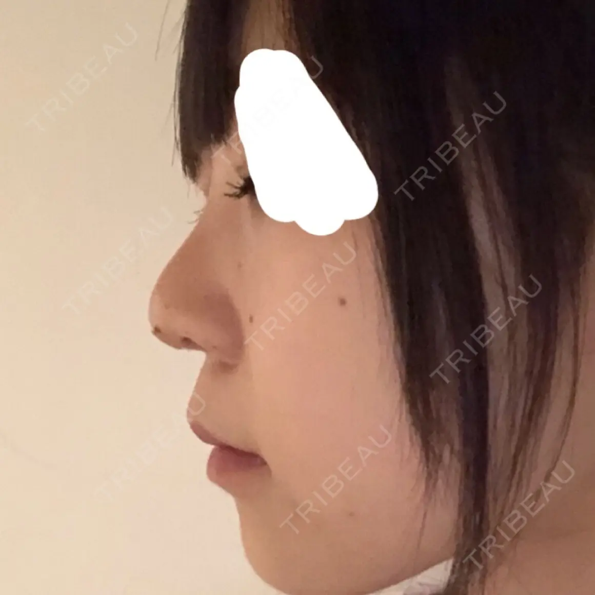 スレッドノーズ メイドユー皮膚科江南店 DAY 0