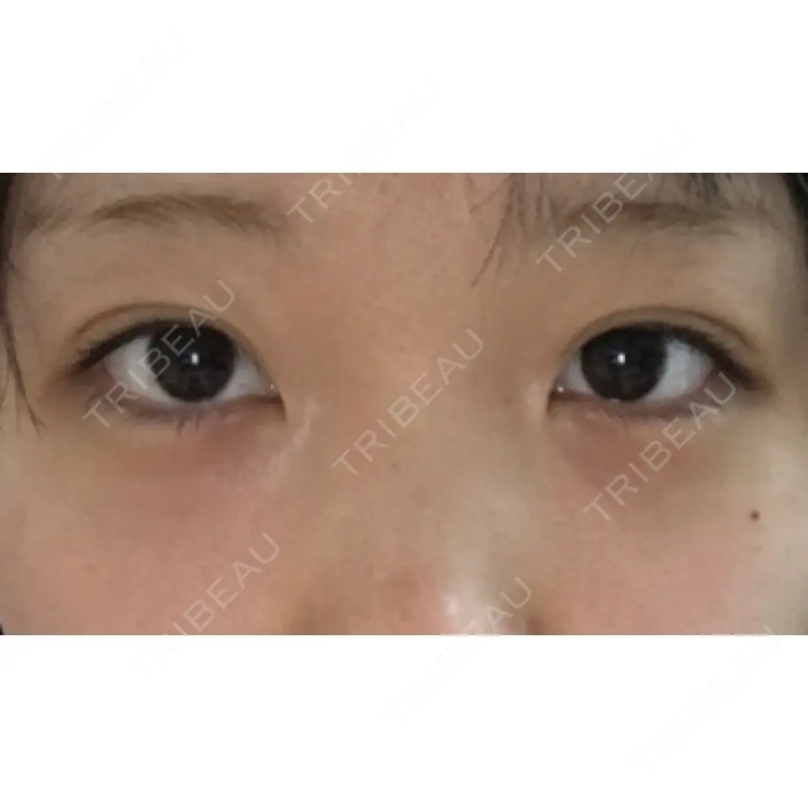 二重埋没 銀座高須クリニック AFTER