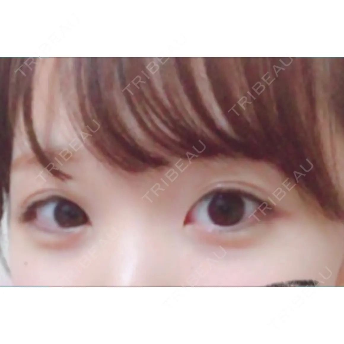 二重埋没 銀座高須クリニック AFTER