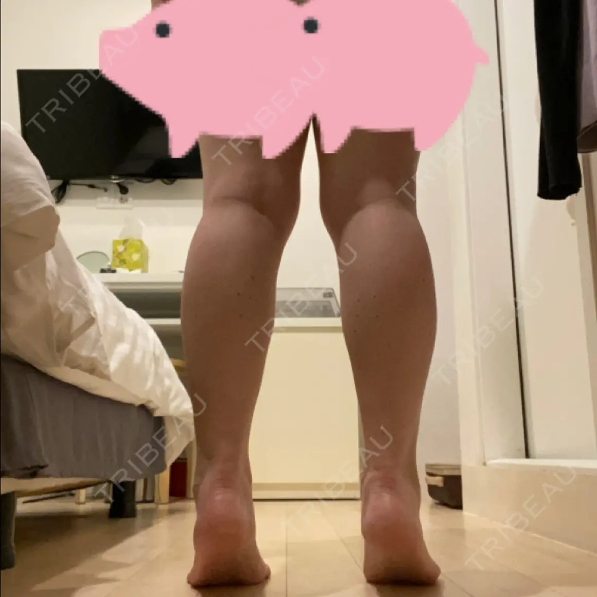 ボトックス（ふくらはぎ） ボセル美容外科 DAY 0