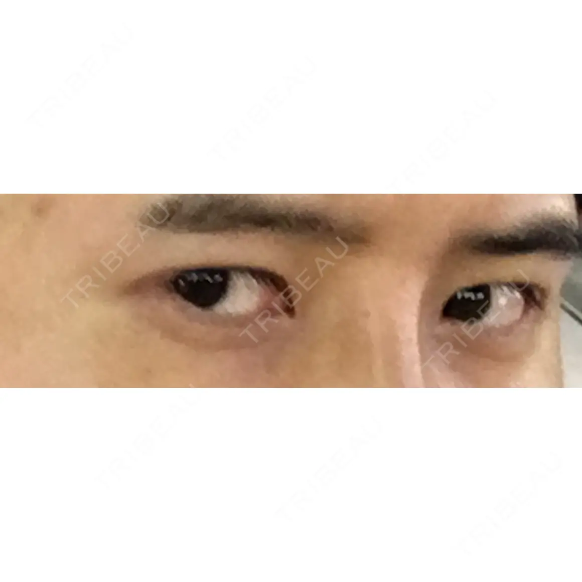 二重埋没 マーブル美容整形外科 DAY 15
