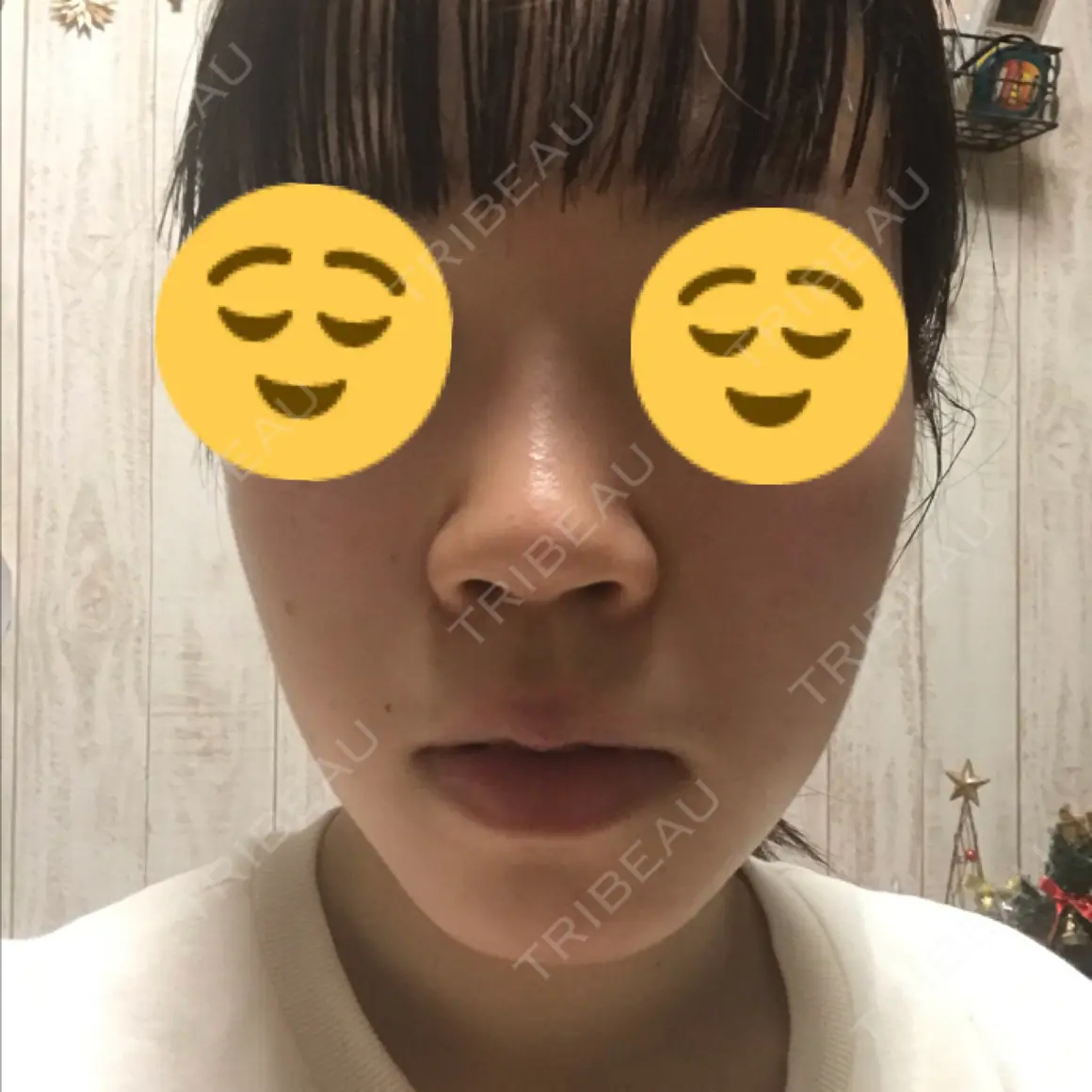 ヒアルロン酸注入（鼻） 恵聖会クリニック 心斎橋院 AFTER