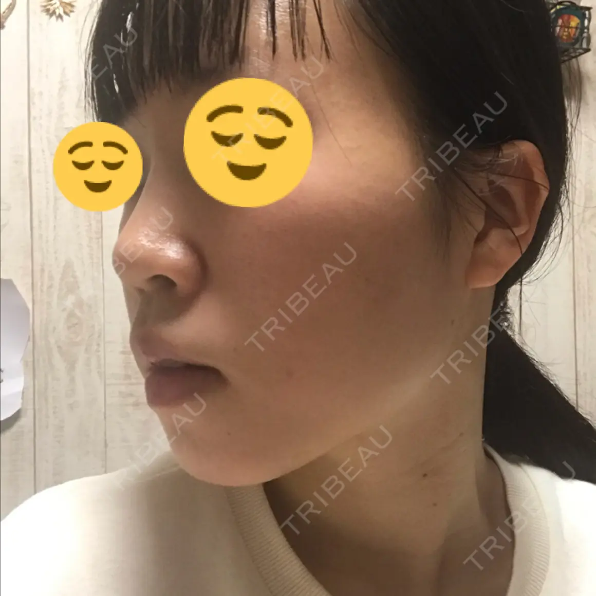 ヒアルロン酸注入（鼻） 恵聖会クリニック 心斎橋院 AFTER