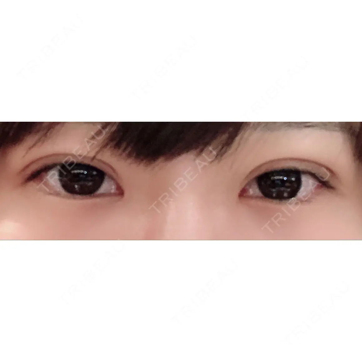 二重埋没 湘南美容クリニック 新宿本院 DAY 0