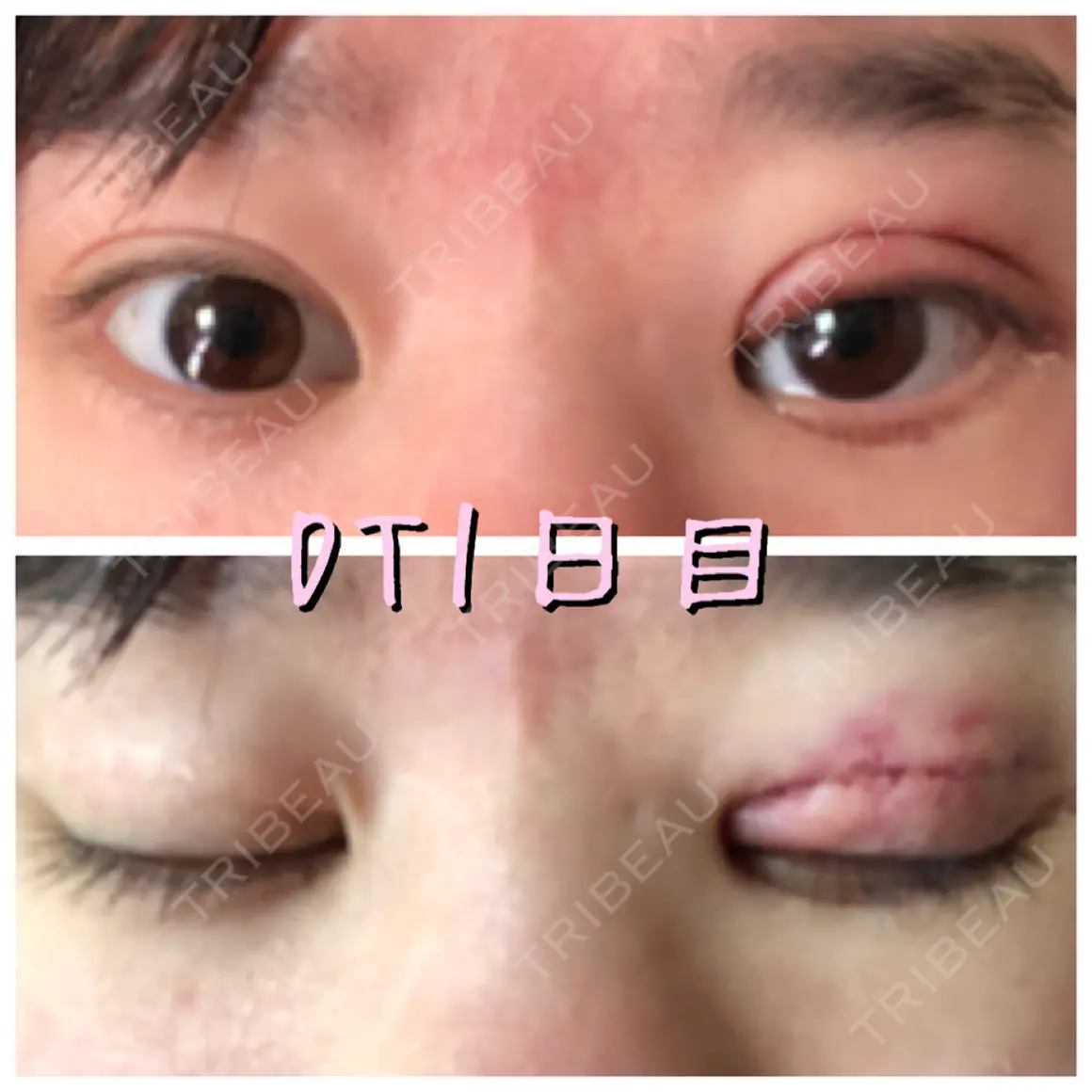二重切開 / 眼瞼下垂（切開） 新前橋かしま眼科形成外科クリニック DAY 1