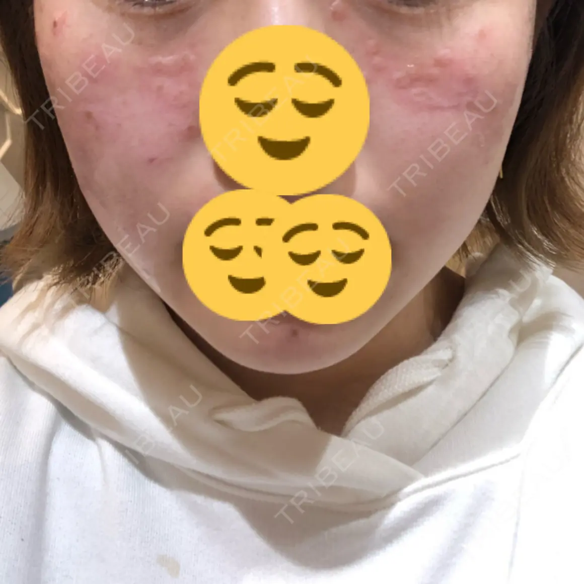 美肌レーザー / シミ取りレーザー / ニキビ治療 UB CLINIC銀座 DAY 0