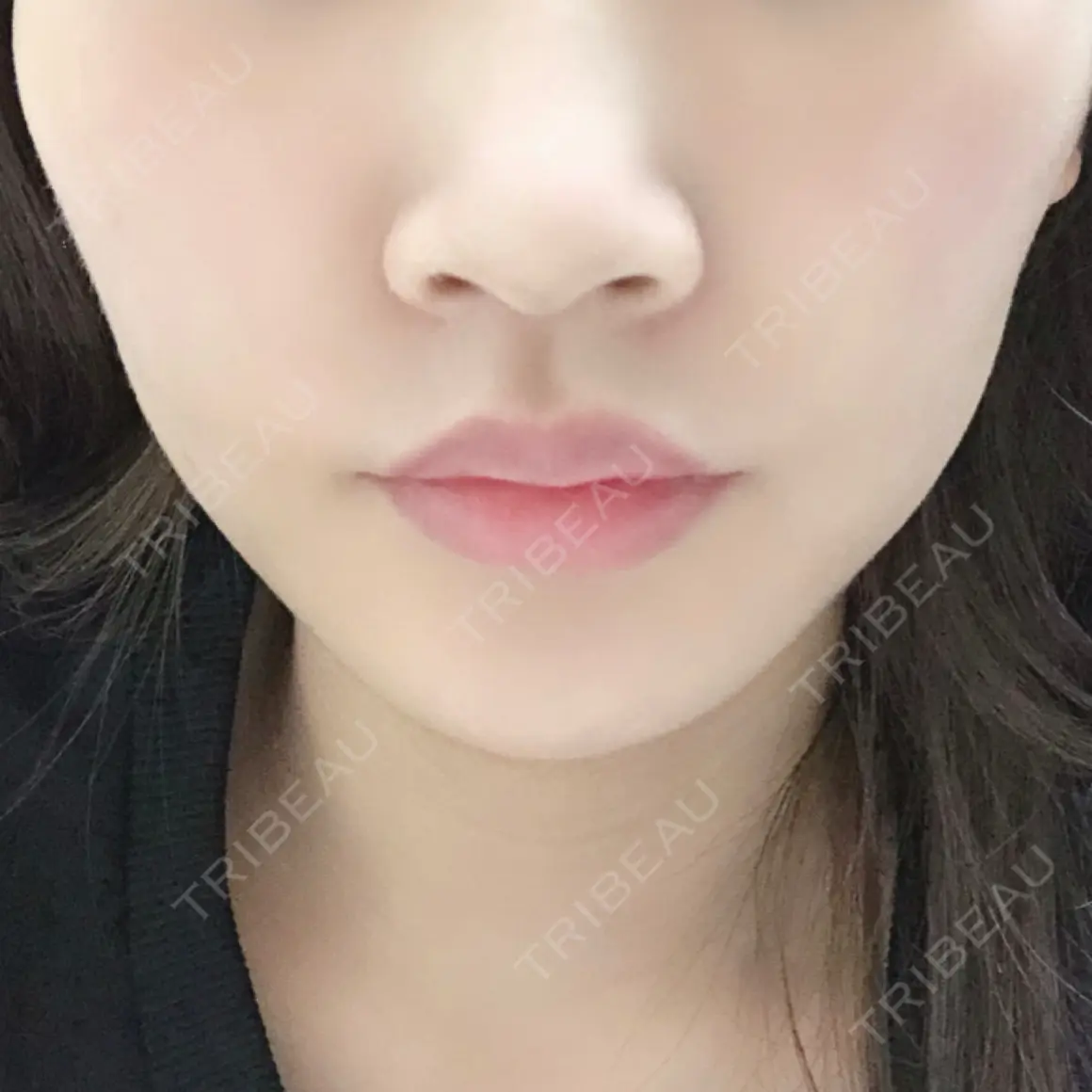 糸リフト ウィーバー美容外科 AFTER