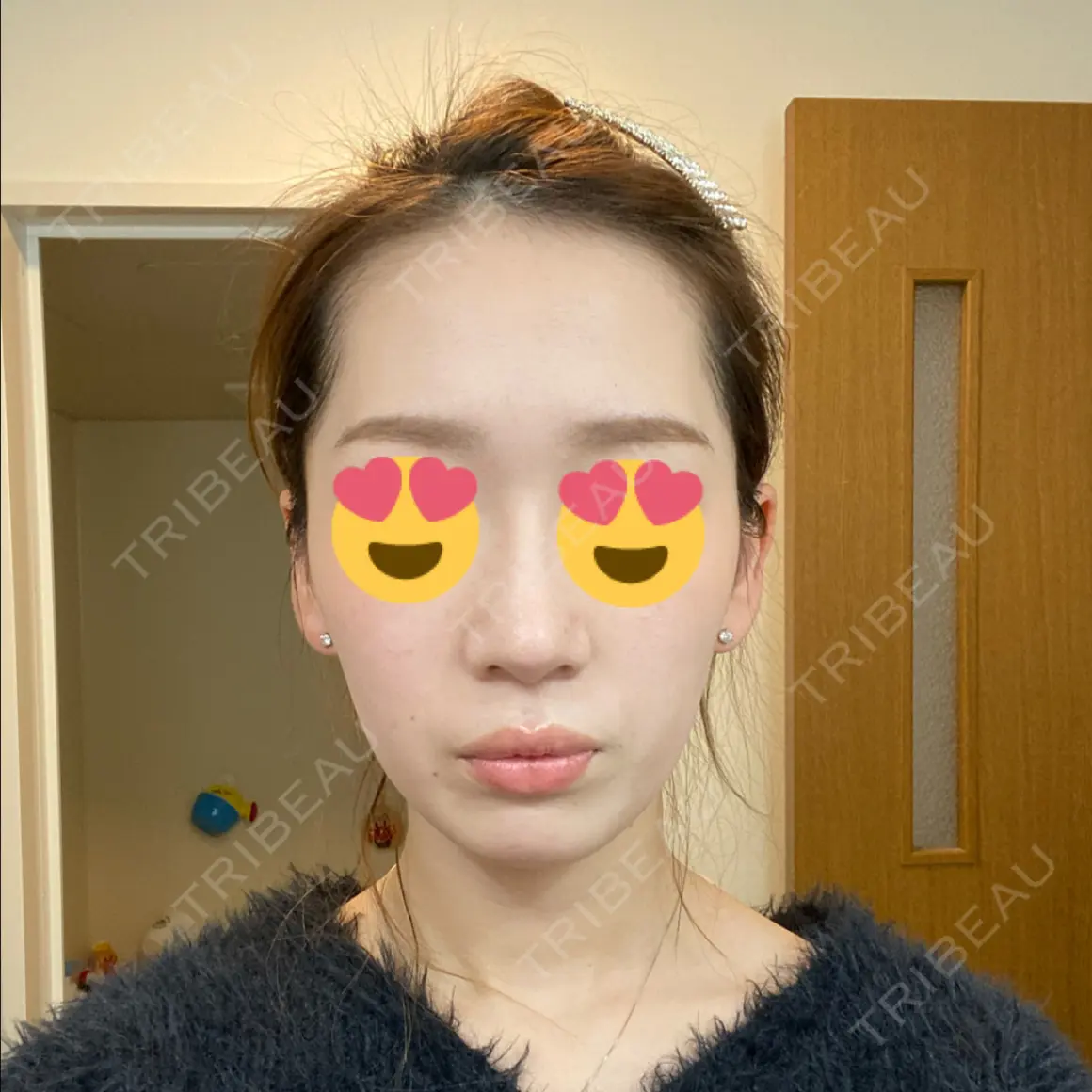 小鼻縮小（切開） / 糸リフト / 鼻尖縮小 / ヒアルロン酸注入（鼻） / ハイフ（顔） ヴェリテクリニック 大阪院 AFTER