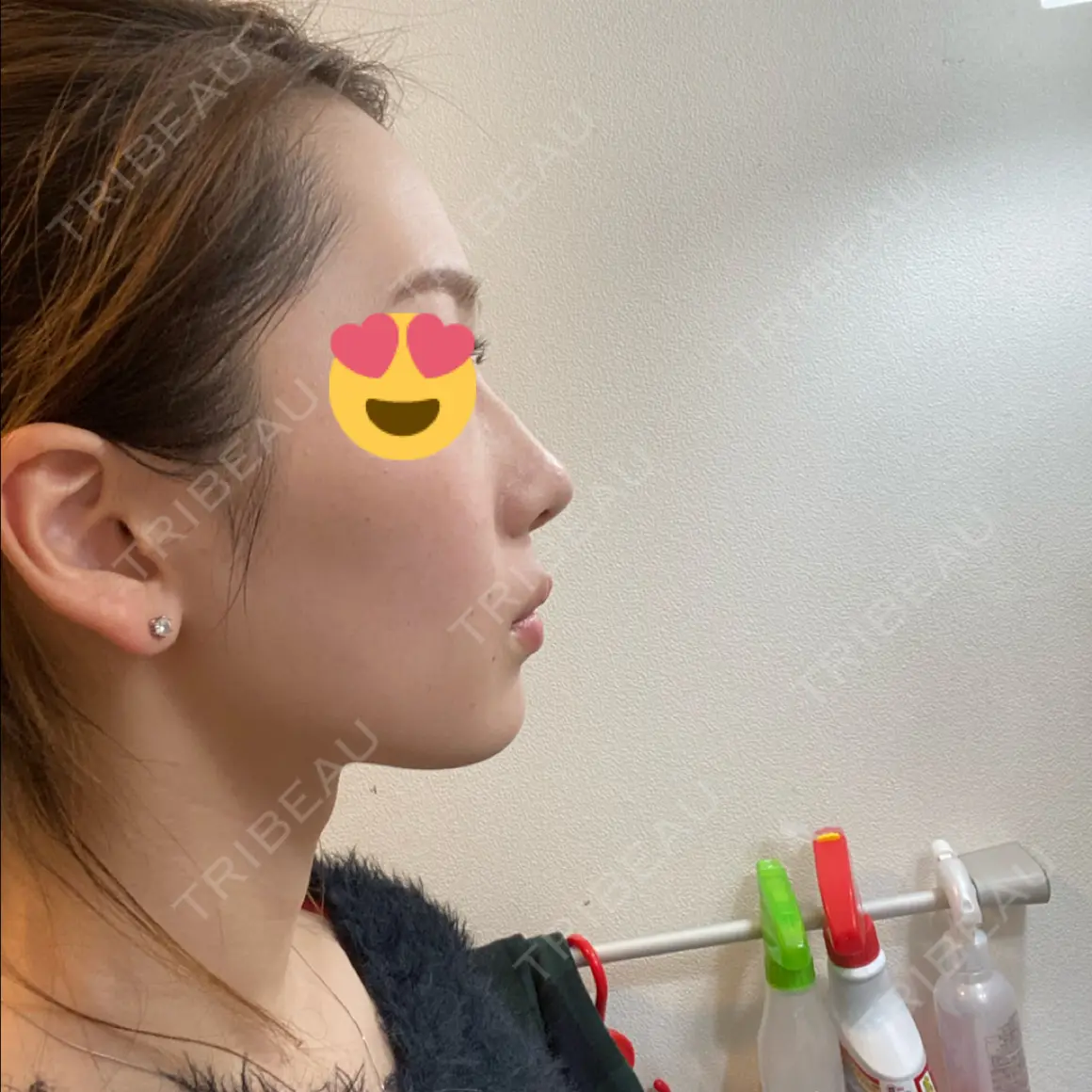 小鼻縮小（切開） / 糸リフト / 鼻尖縮小 / ヒアルロン酸注入（鼻） / ハイフ（顔） ヴェリテクリニック 大阪院 AFTER