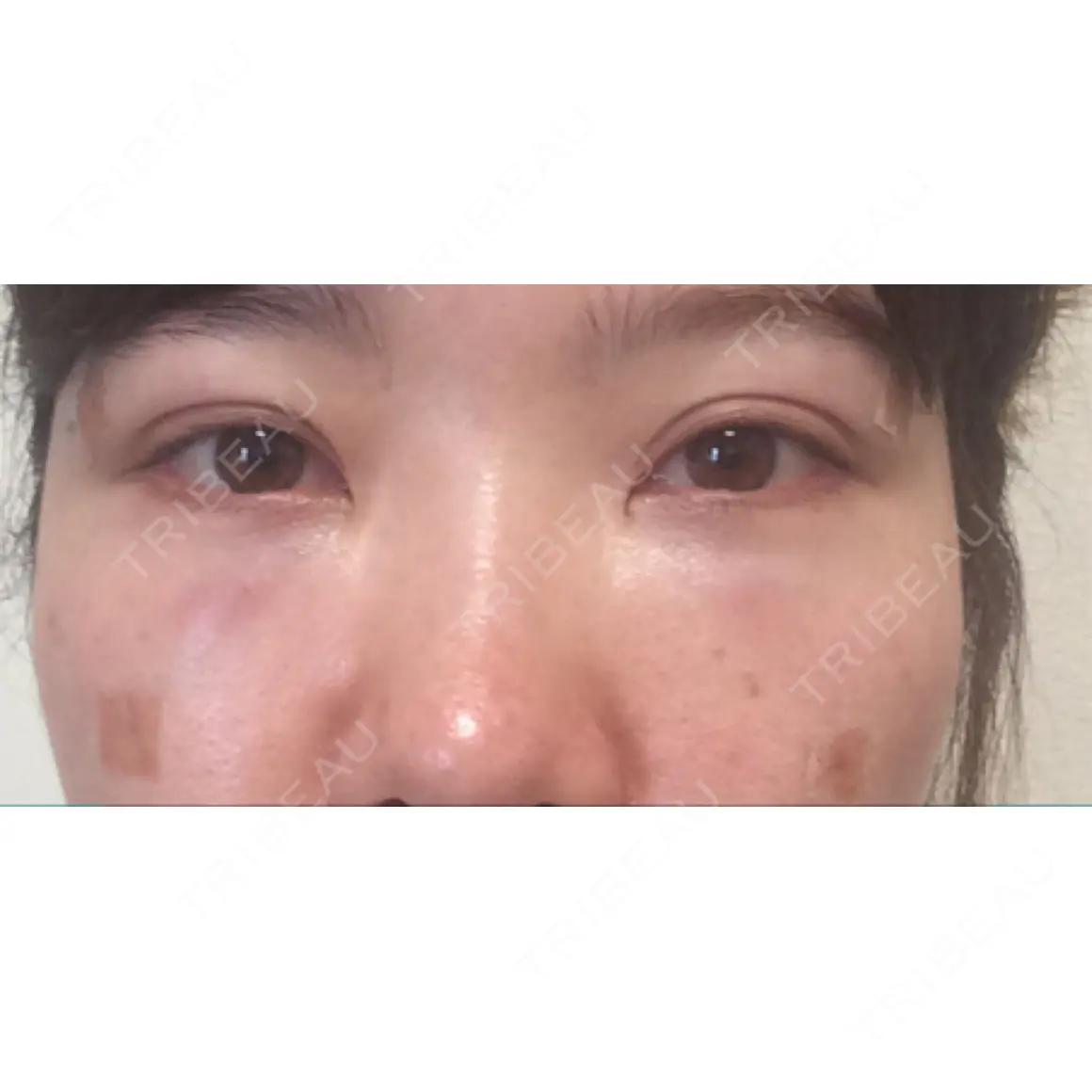 クマ治療 セオリークリニック DAY 0