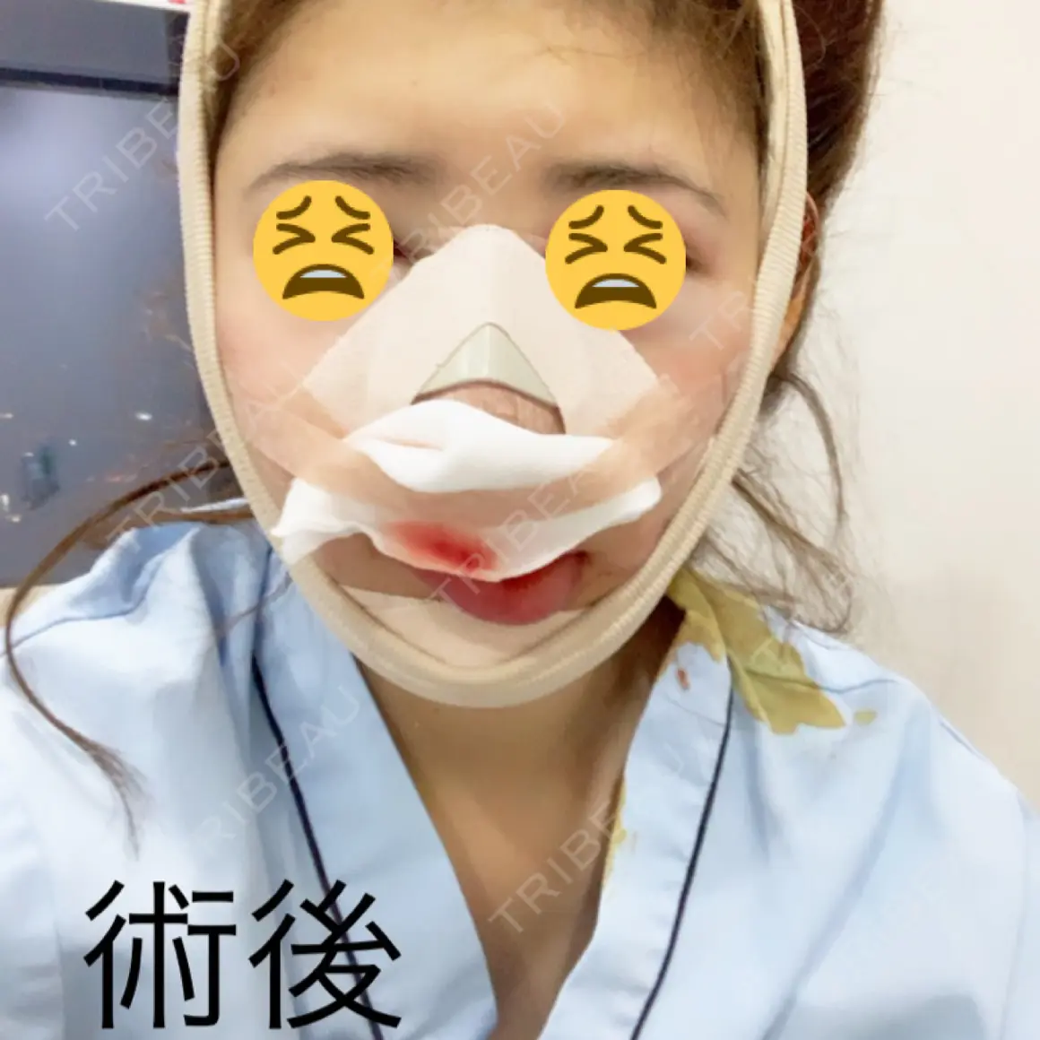 骨切り（あご） / 骨削り（エラ） / 軟骨移植 / 鼻修正 / 輪郭修正 ノート美容外科 DAY 0