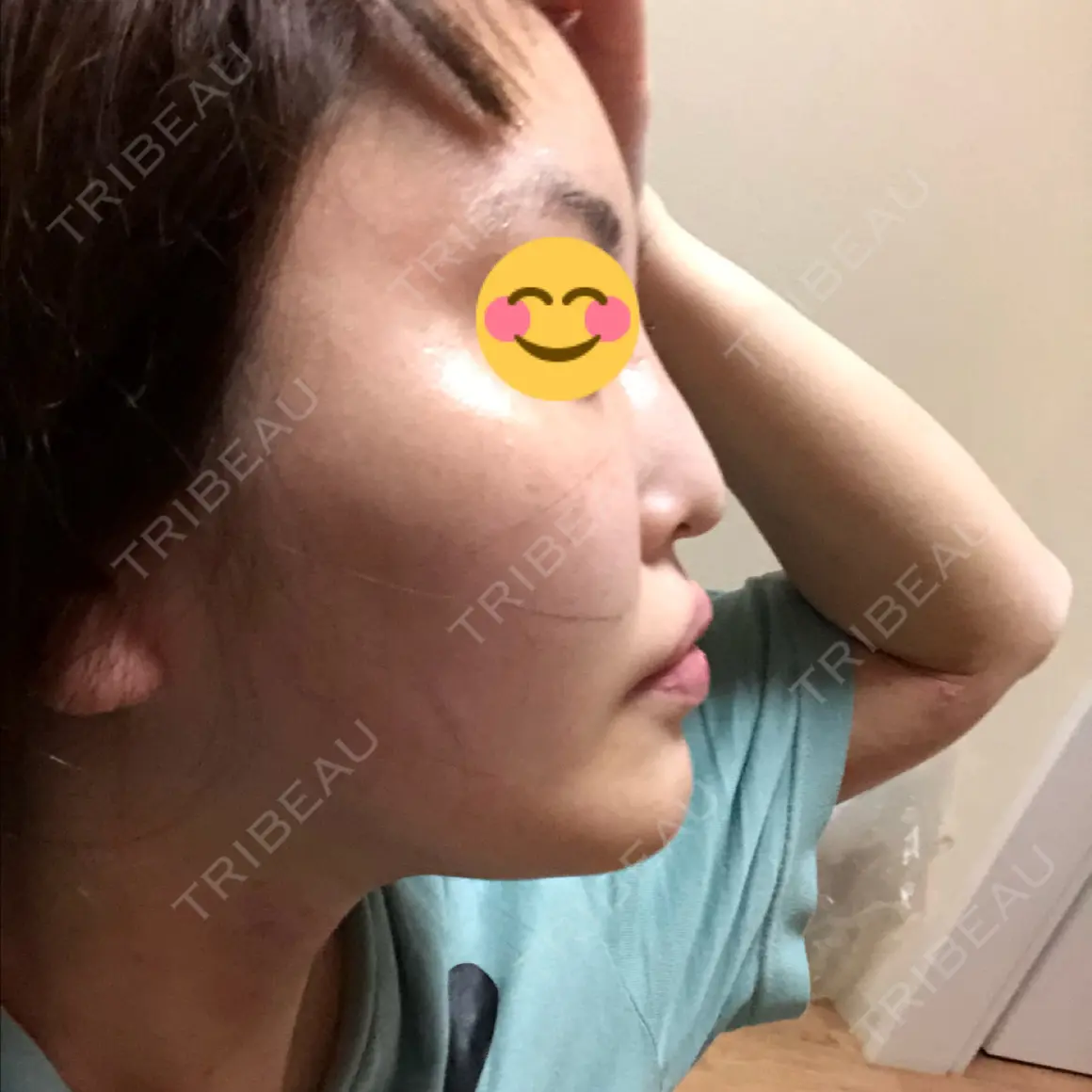 隆鼻術 / 鼻尖形成（切開） / 軟骨移植 / ワシ鼻修正・ハンプ切除 湘南美容クリニック 札幌院 AFTER