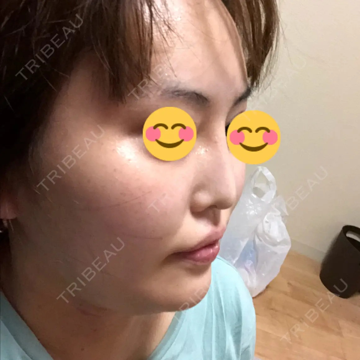 隆鼻術 / 鼻尖形成（切開） / 軟骨移植 / ワシ鼻修正・ハンプ切除 湘南美容クリニック 札幌院 AFTER