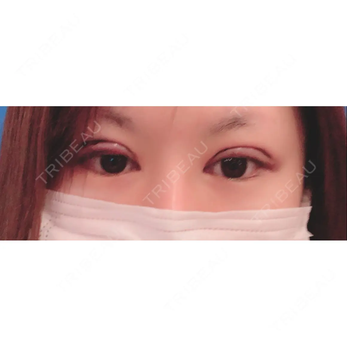 二重切開 / 目元修正 オペラ整形外科 DAY 0