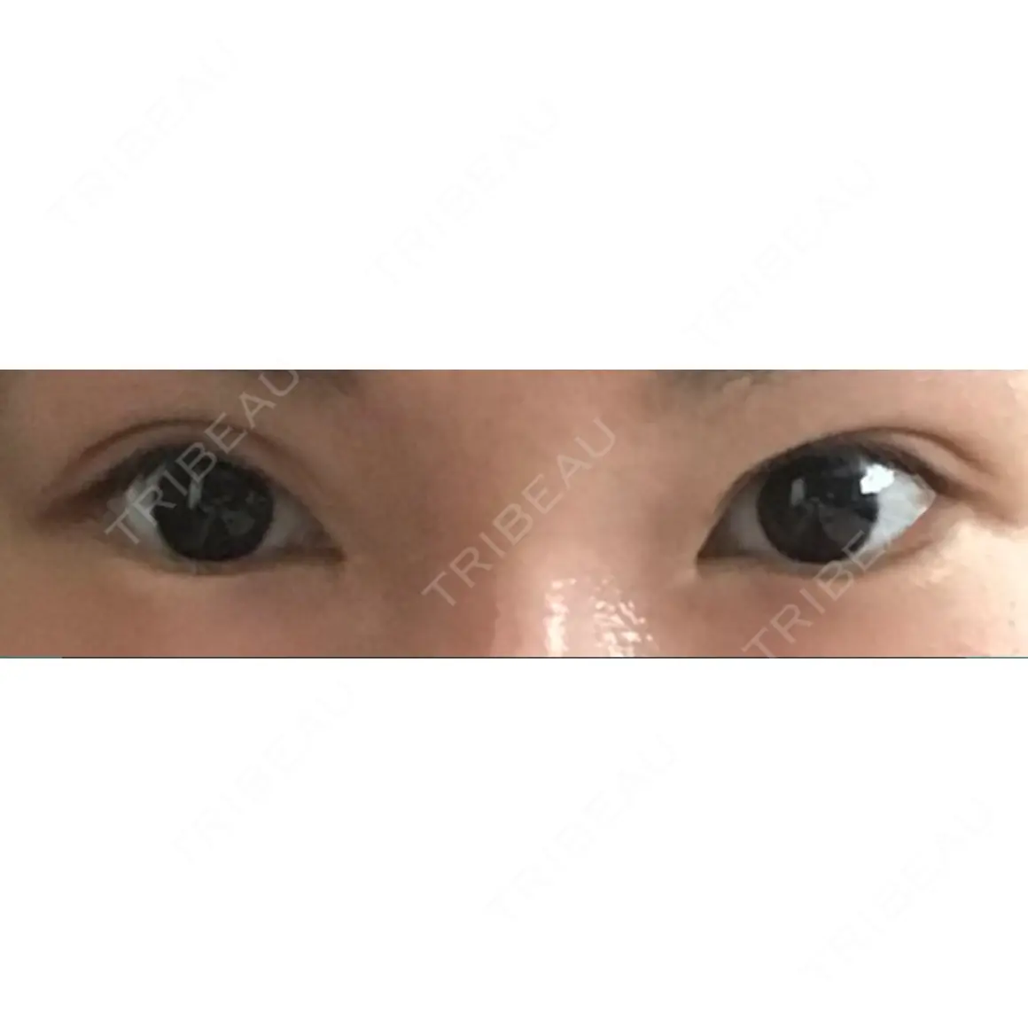 二重切開 / 眼瞼下垂（切開） / 上まぶたたるみ取り / 上まぶたの脂肪取り ヴェリテクリニック 名古屋院 AFTER
