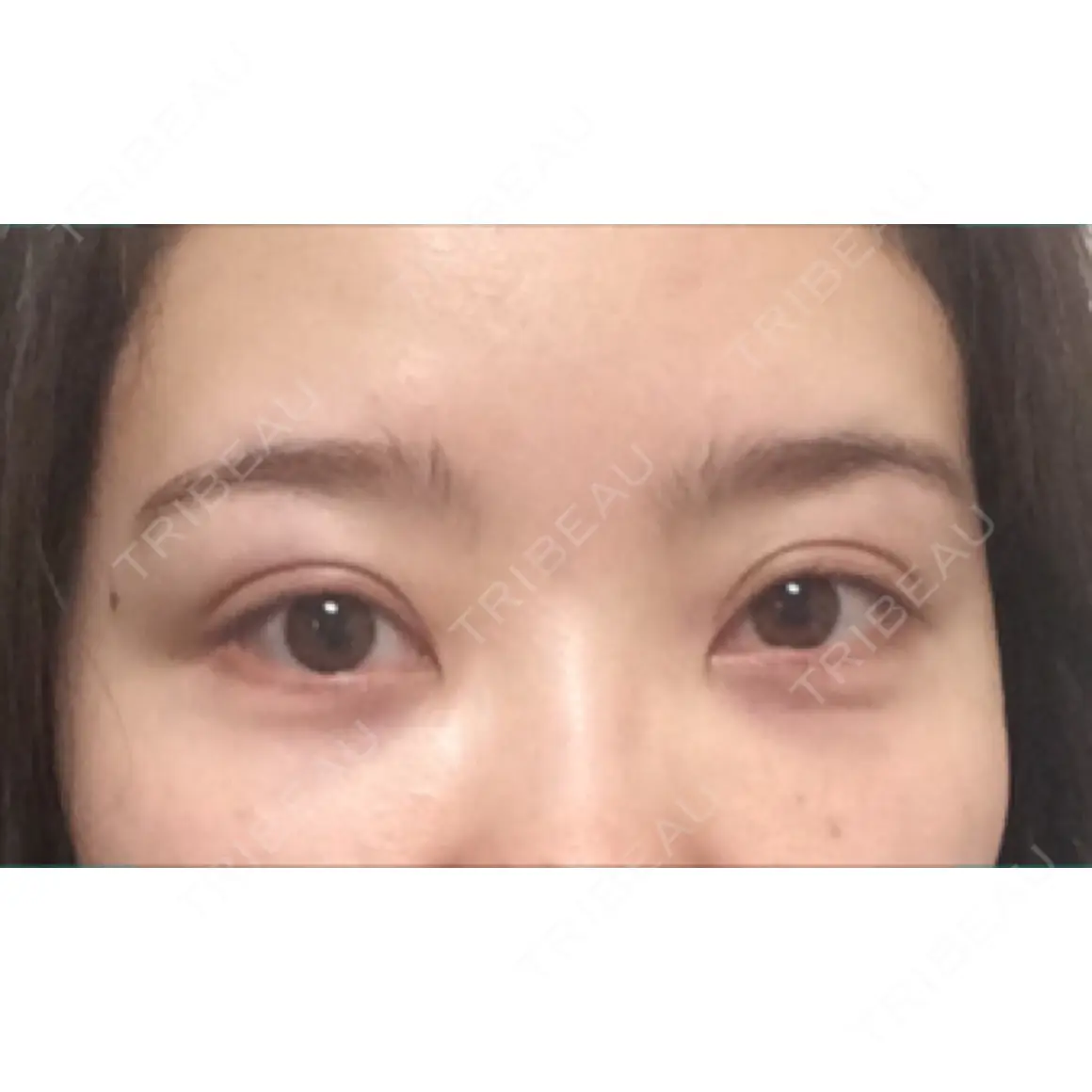 クマ治療 セオリークリニック AFTER