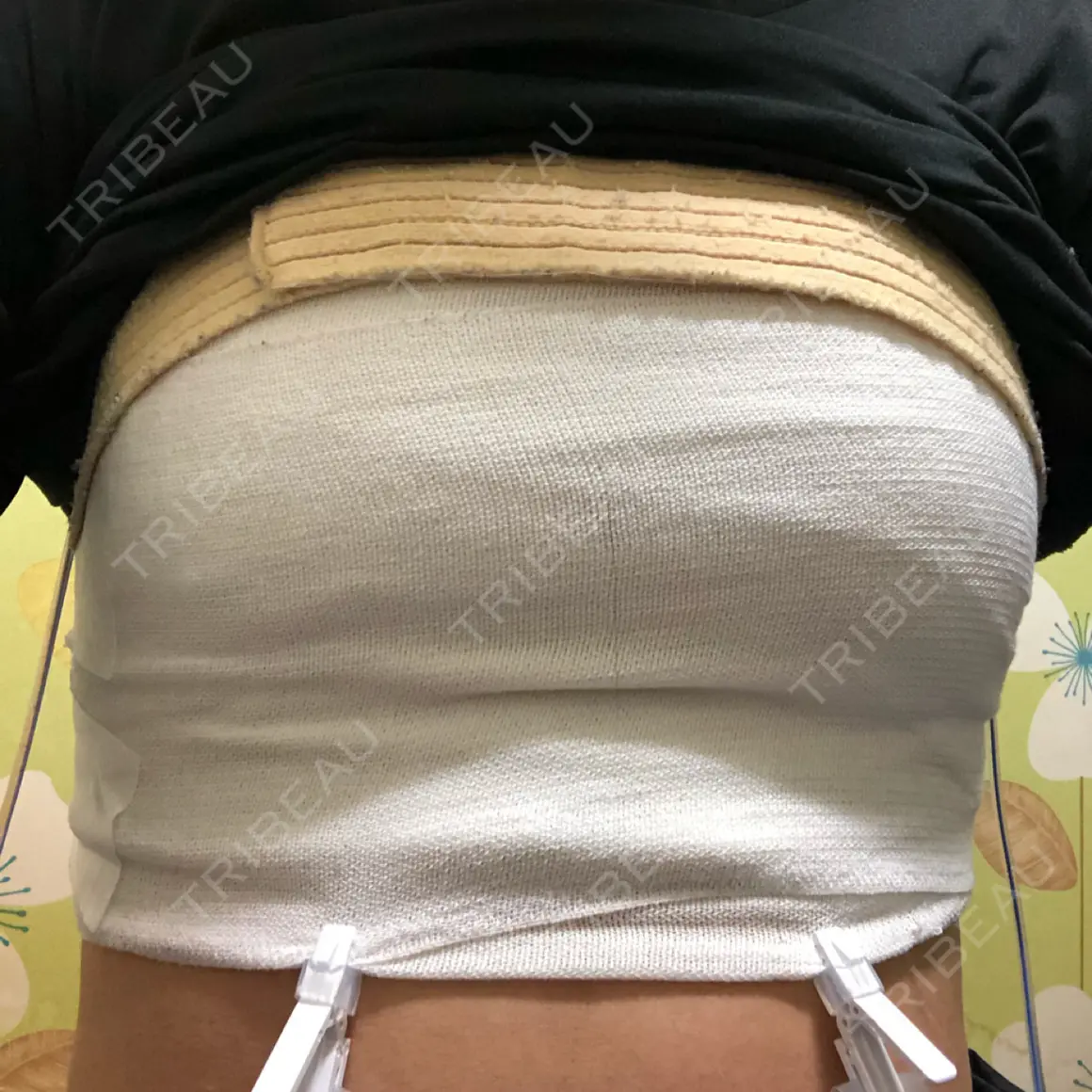 豊胸（シリコンバッグ） マーブル美容整形外科 DAY 0