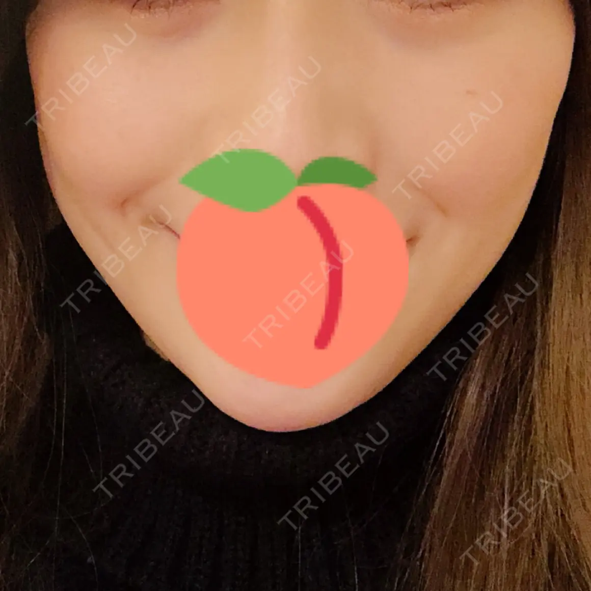 糸リフト ウィーバー美容外科 AFTER