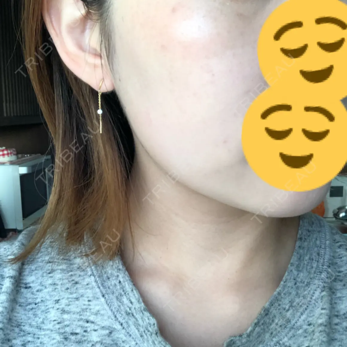 美肌レーザー / シミ取りレーザー / ニキビ治療 UB CLINIC銀座 AFTER