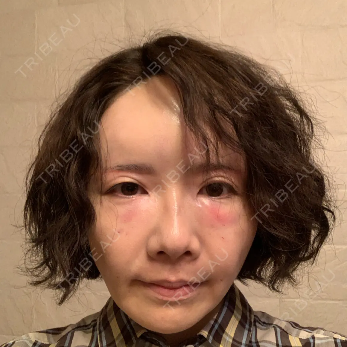 脂肪注入（輪郭） 湘南美容クリニック 札幌院 DAY 0