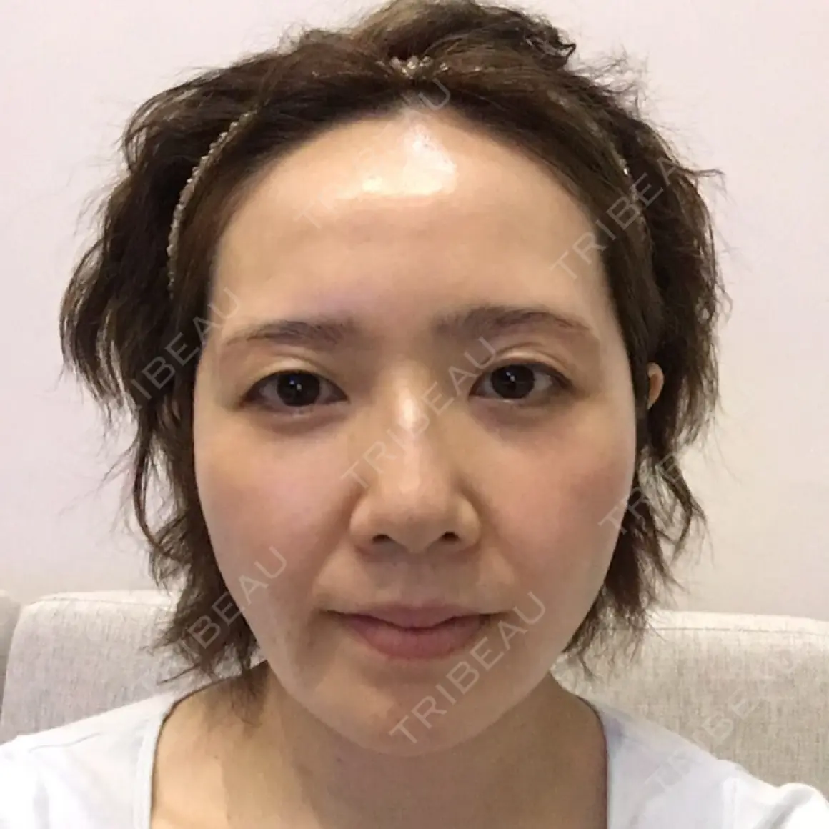 上まぶたの脂肪取り 湘南美容クリニック 札幌院 AFTER