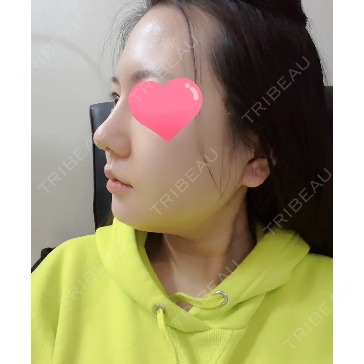 隆鼻術 / 鼻尖形成（切開） / 糸リフト / 骨削り（エラ） / 骨削り（頬） / 脂肪吸引（顔） RG整形外科（旧リオン整形外科） DAY 11