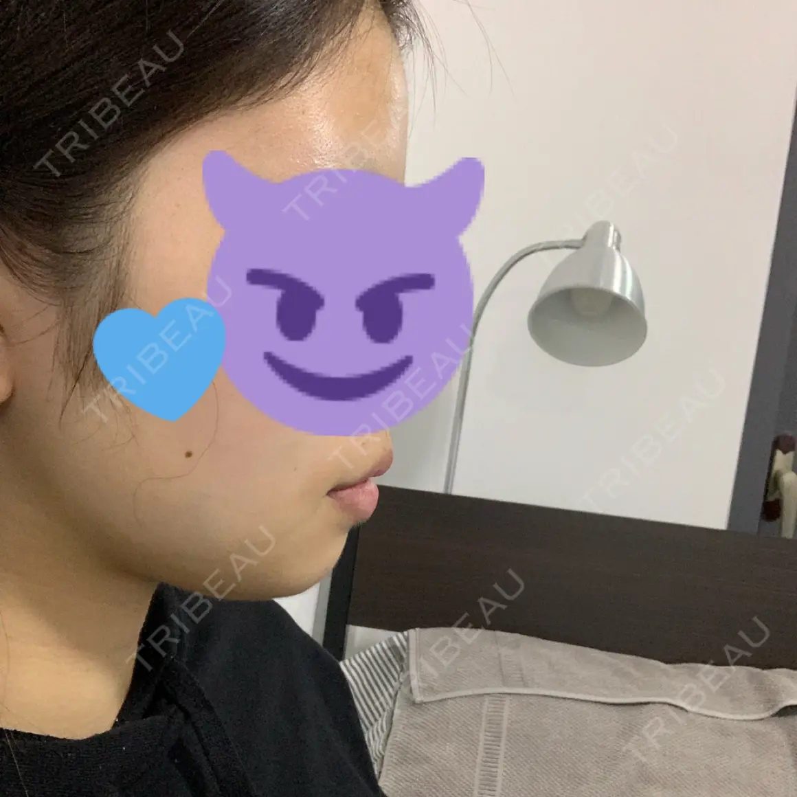 ボトックス（あご） / ヒアルロン酸注入（あご） / ボトックス（エラ・小顔） / 脂肪溶解注射（顔） クリニックA.O. DAY 0