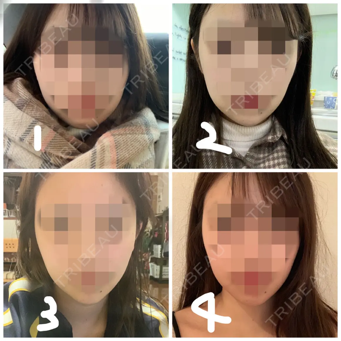 ボトックス（あご） / ヒアルロン酸注入（あご） / ボトックス（エラ・小顔） / 脂肪溶解注射（顔） クリニックA.O. AFTER