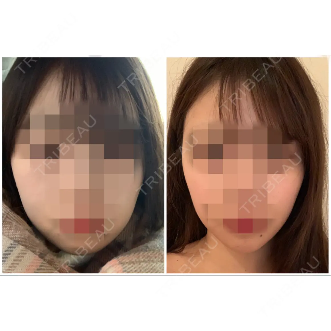 ボトックス（あご） / ヒアルロン酸注入（あご） / ボトックス（エラ・小顔） / 脂肪溶解注射（顔） クリニックA.O. AFTER