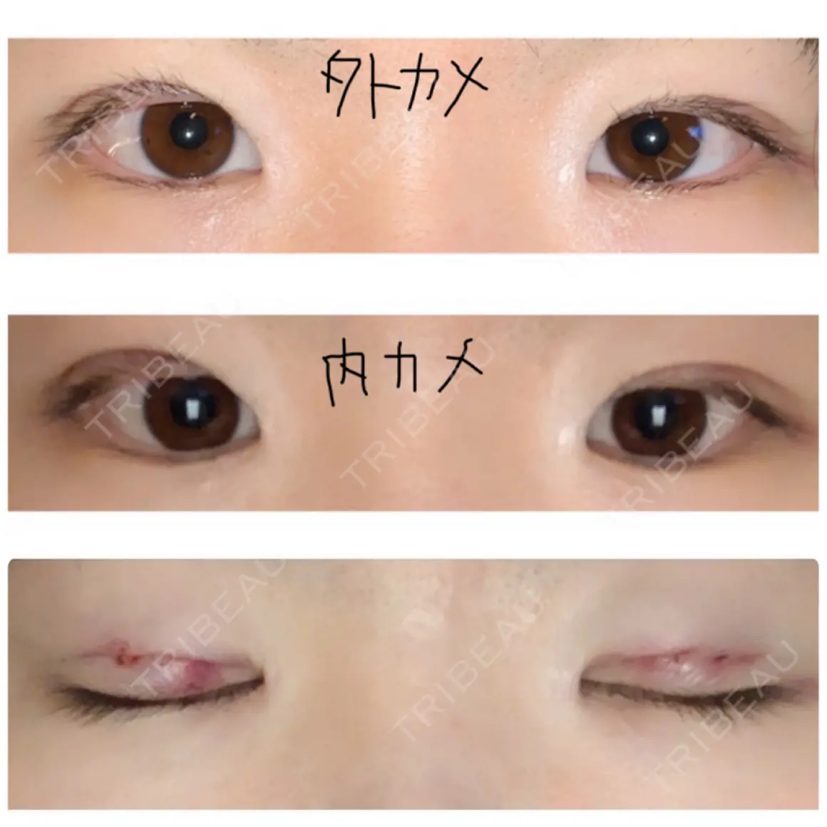 自然癒着法 マーブル美容整形外科 DAY 0