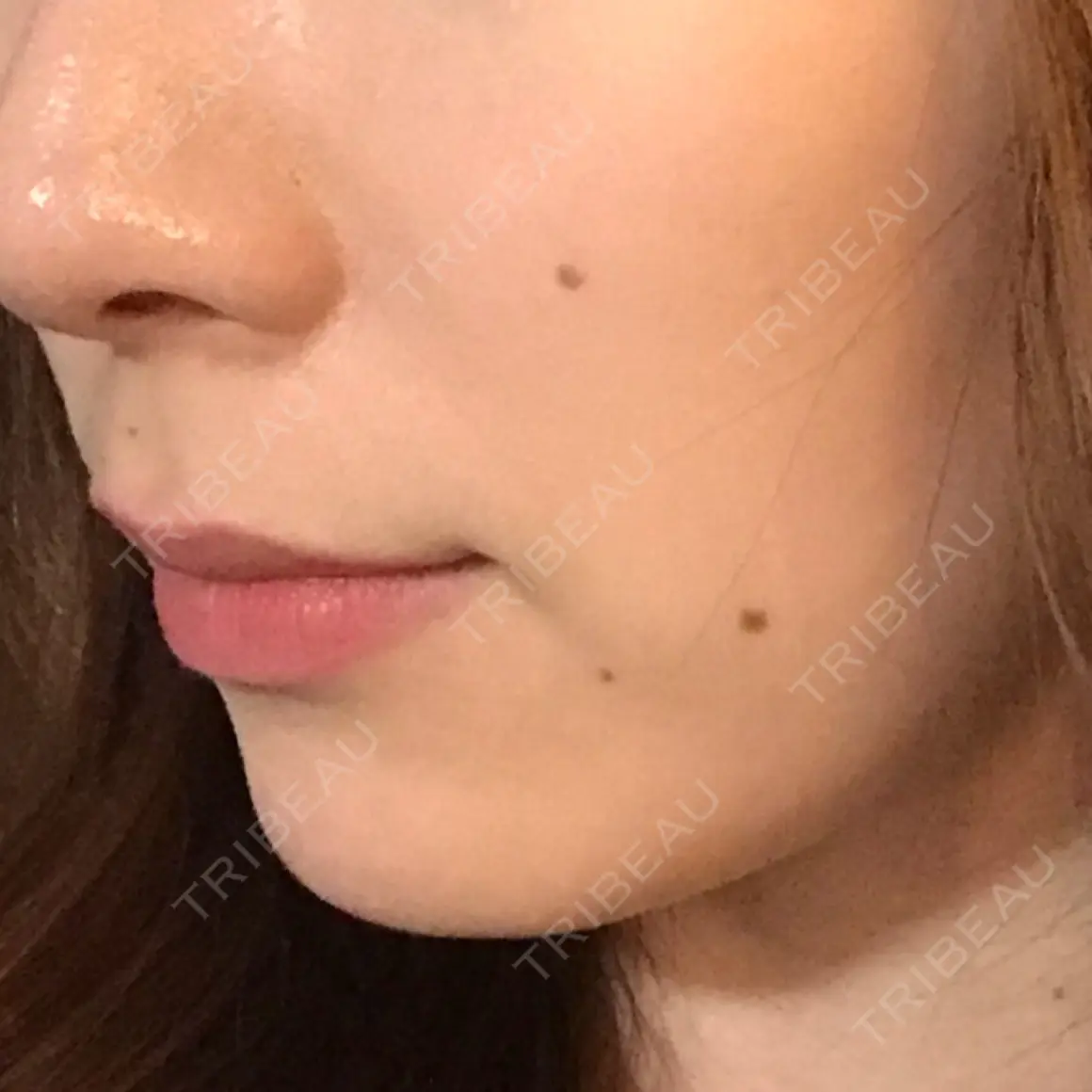 ボトックス（エラ・小顔） 湘南美容クリニック 新宿本院 AFTER