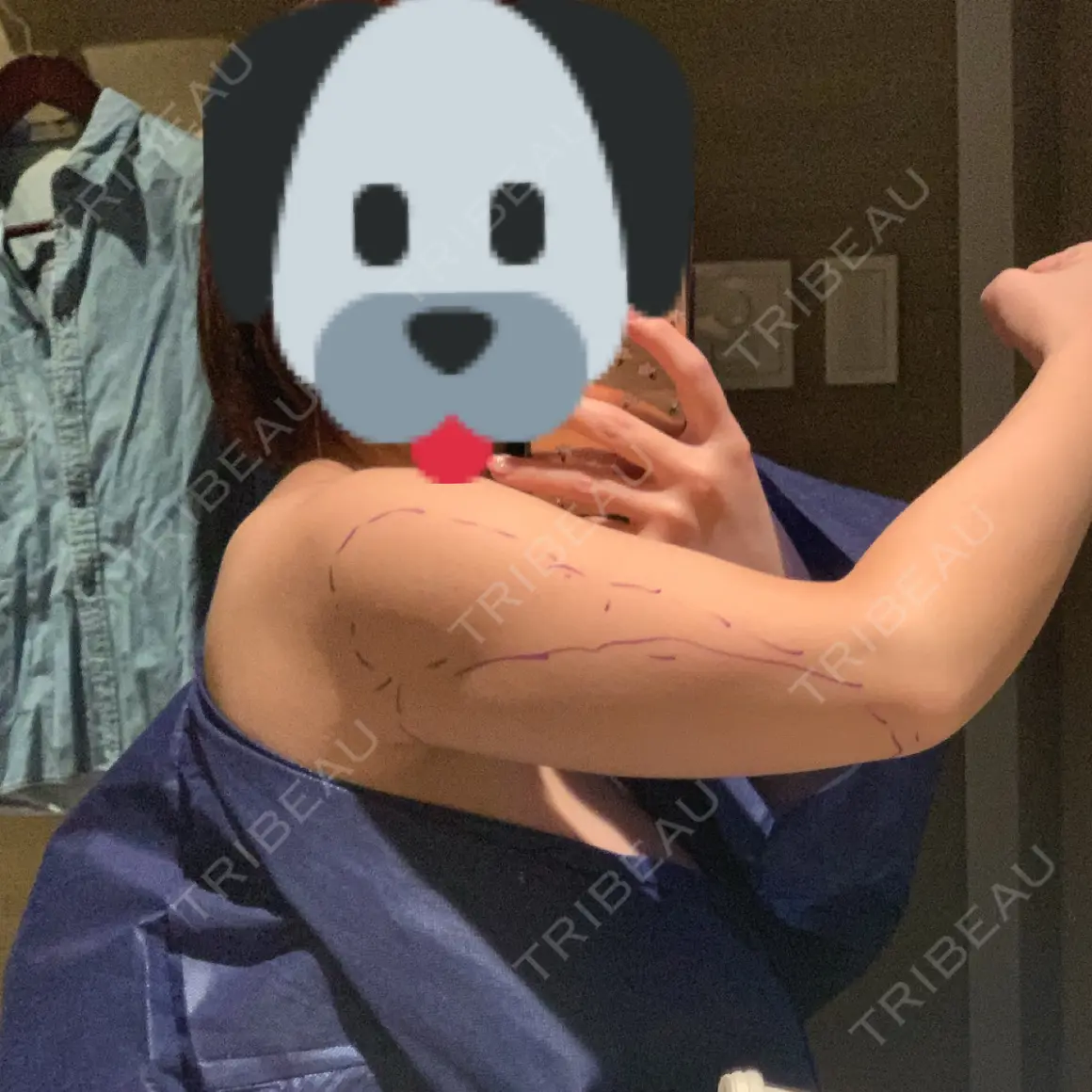 脂肪吸引（二の腕） 聖心美容クリニック 六本木院 DAY 0