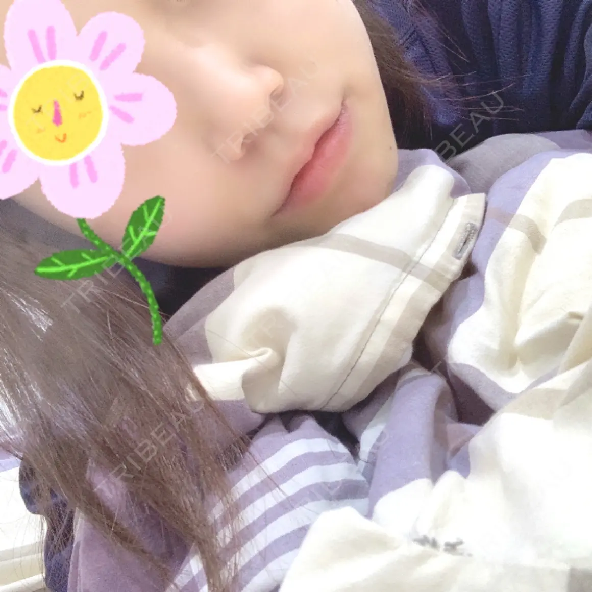 ヒアルロン酸注入（唇） / ボトックス（口角） エートップ美容整形外科 DAY 0