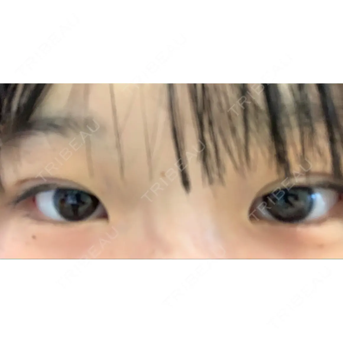 二重埋没 湘南美容クリニック 高松院 DAY 0