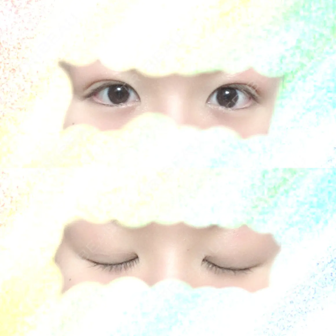 二重埋没 共立美容外科 大宮院 AFTER