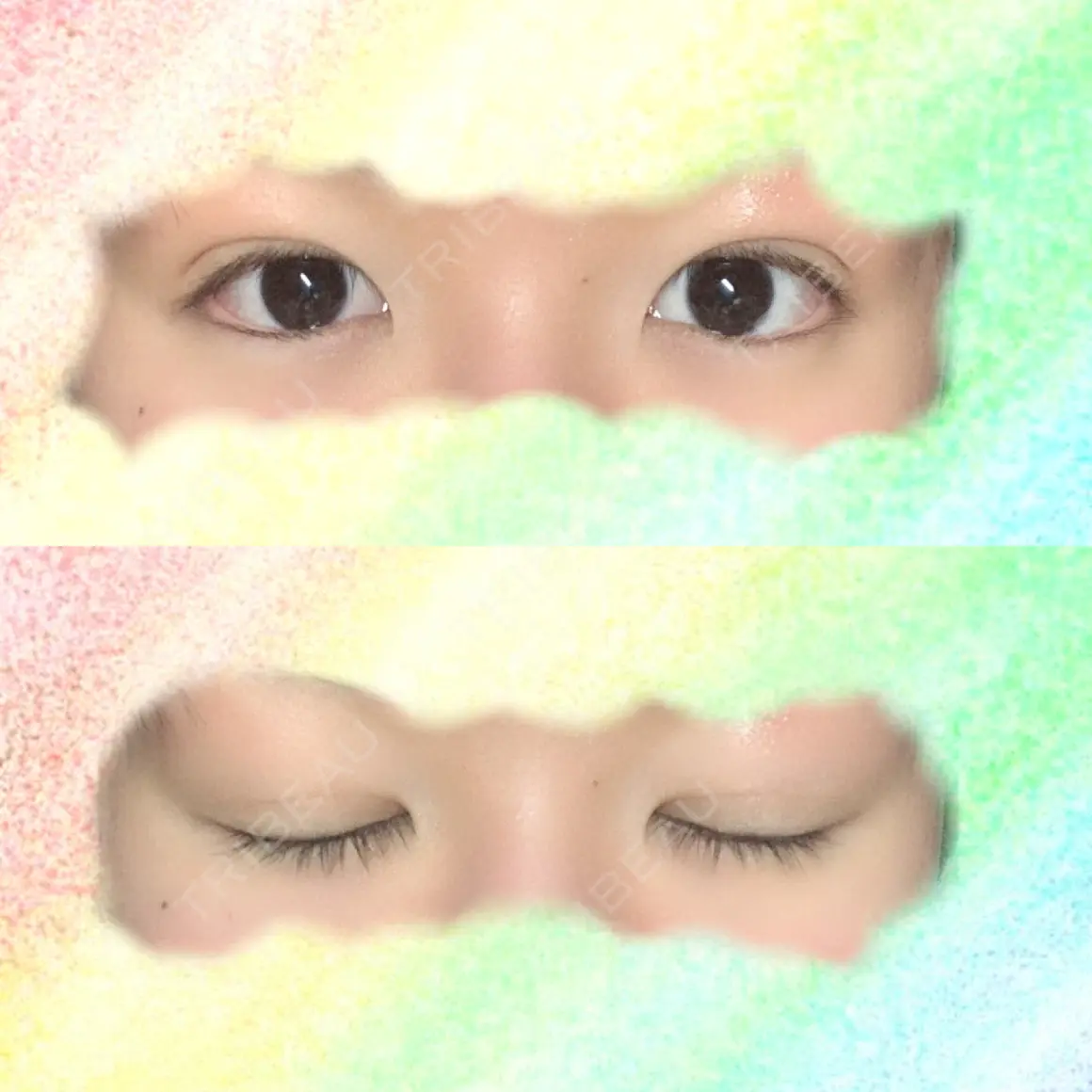 二重埋没 共立美容外科 大宮院 AFTER