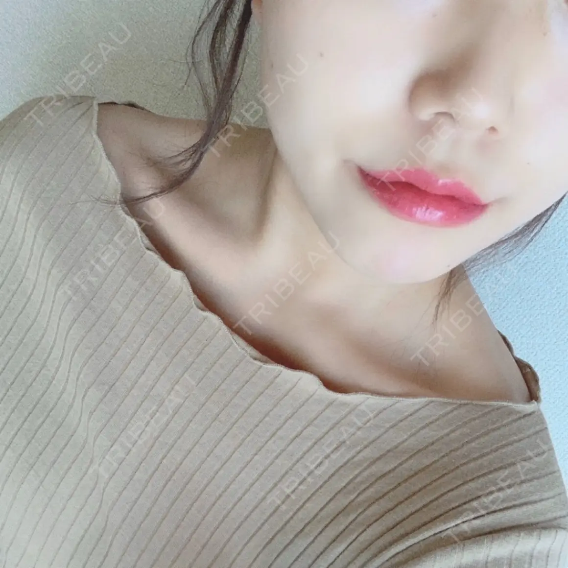ヒアルロン酸注入（唇） / ボトックス（口角） エートップ美容整形外科 AFTER