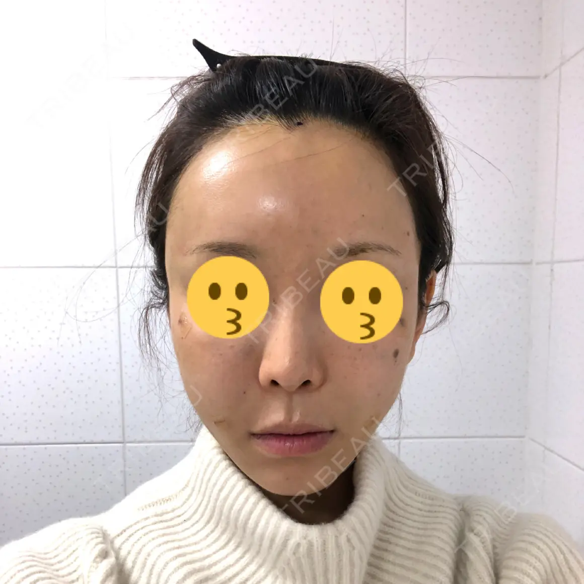 額を丸く / 脂肪注入（肌） / こめかみ形成 / 脂肪注入（額） / 脂肪注入（輪郭） / PRP皮膚再生療法 トップフェイス整形外科 DAY 0