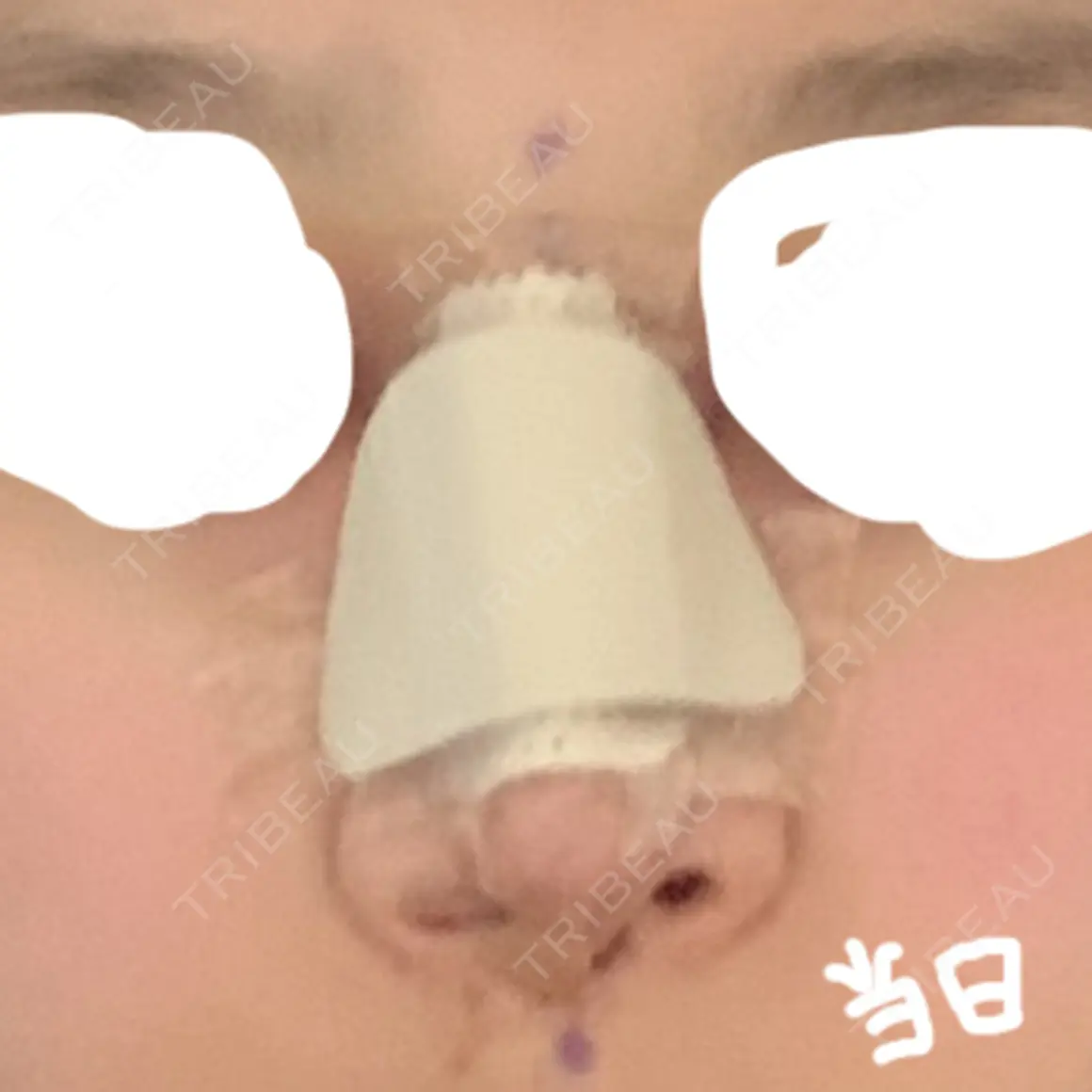 鼻中隔延長（切開） / 小鼻縮小（切開） マーブル美容整形外科 DAY 0
