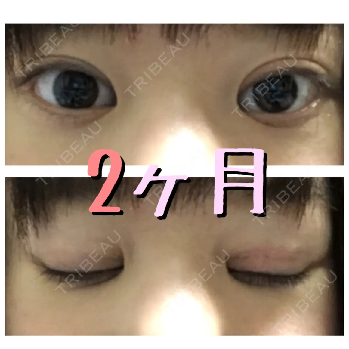 二重切開 / 眼瞼下垂（切開） 新前橋かしま眼科形成外科クリニック AFTER