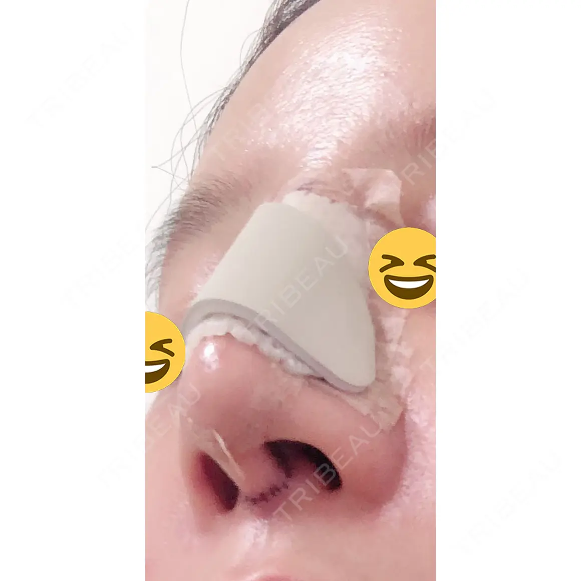 鼻中隔延長（切開） / 鼻修正 マーブル美容整形外科 DAY 3
