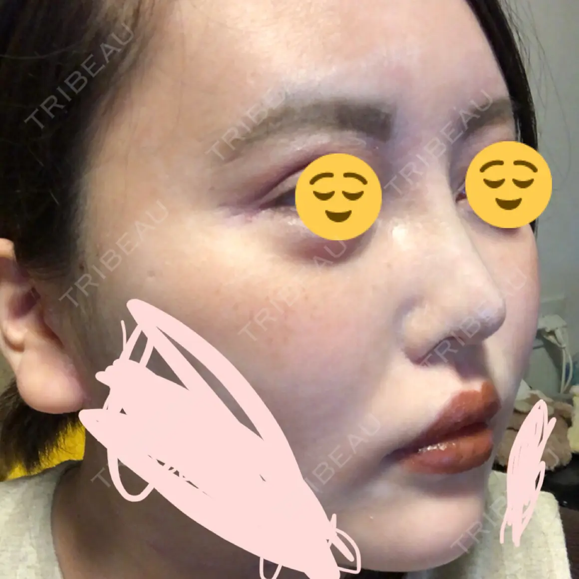 隆鼻術 / 鼻尖形成（切開） / 軟骨移植 湘南美容クリニック 札幌院 AFTER