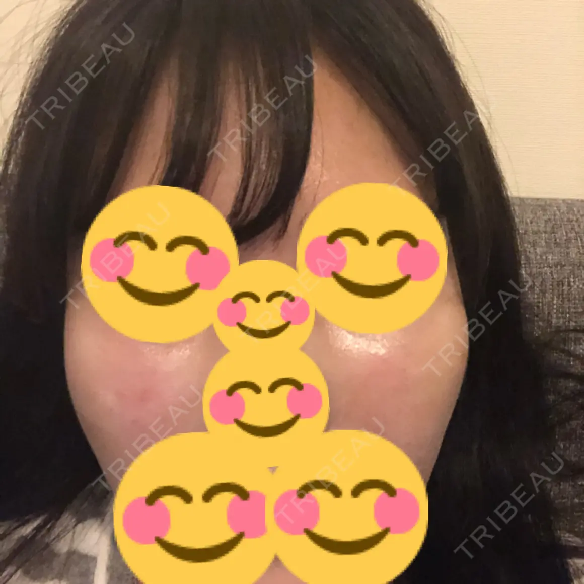 ヒアルロン酸注入（頬） id美容クリニック 銀座院 DAY 1