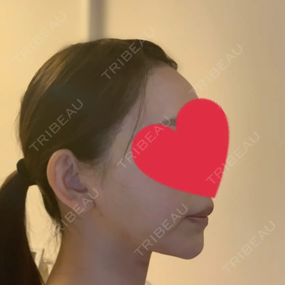 ヒアルロン酸注入（あご） / ボトックス（肩） / フラクショナルレーザー（毛穴・ニキビ跡） 青山ラジュボークリニック AFTER
