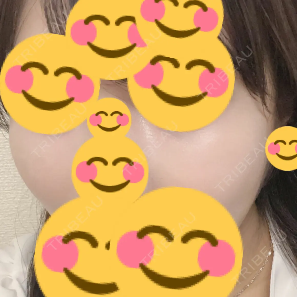 ヒアルロン酸注入（頬） id美容クリニック 銀座院 AFTER