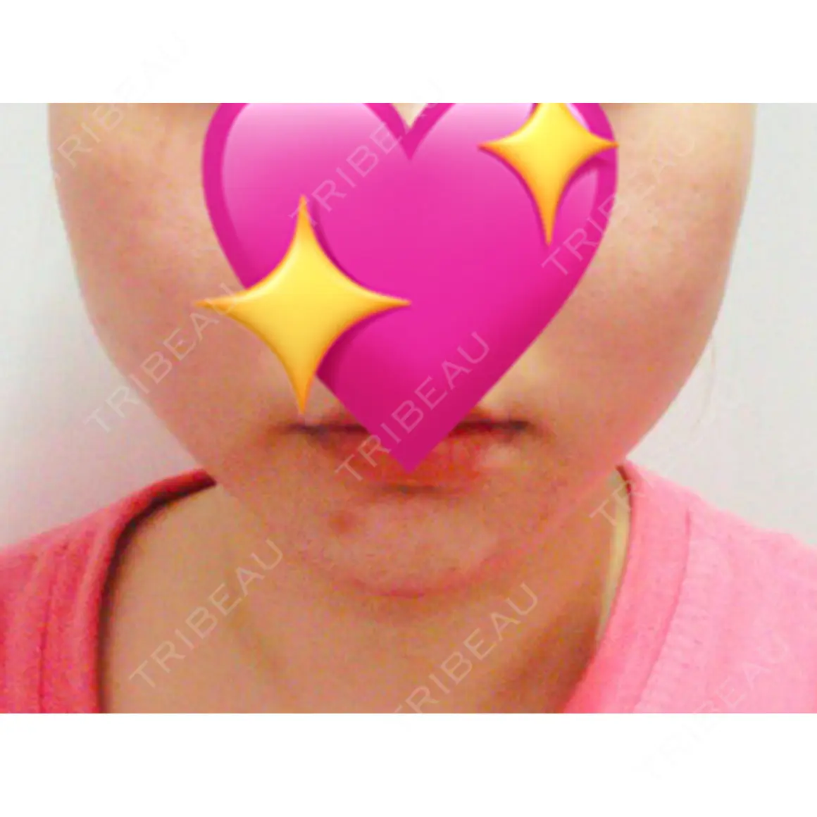 糸リフト / 脂肪吸引（顔） / ボトックス（エラ・小顔） マーブル美容整形外科 DAY 14