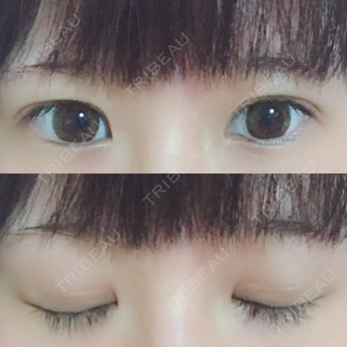 二重切開 / タレ目形成・グラマラスライン（切開） 高須クリニック 名古屋院 AFTER