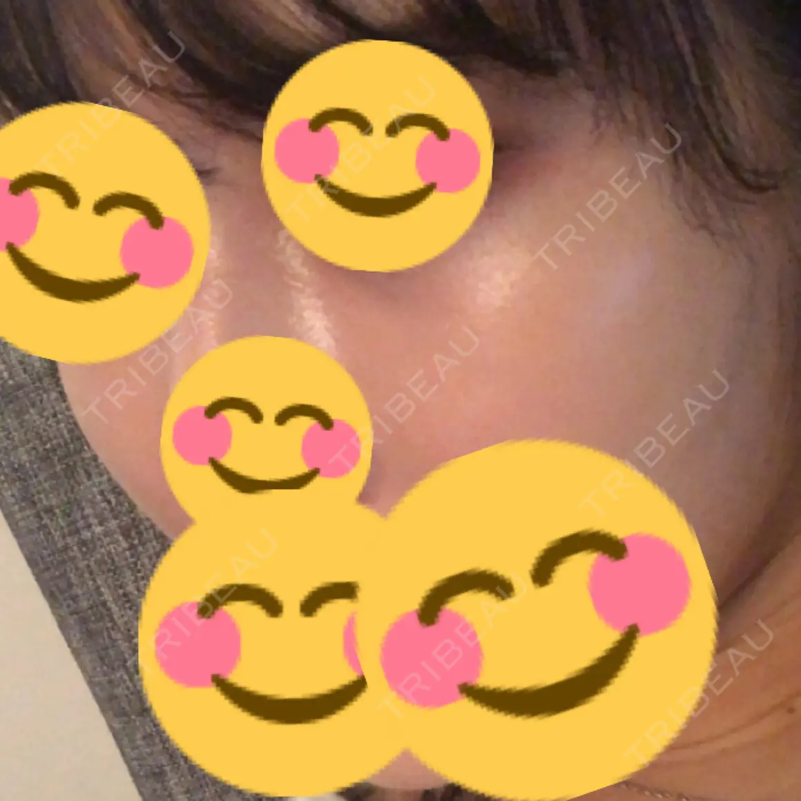 ヒアルロン酸注入（頬） id美容クリニック 銀座院 AFTER